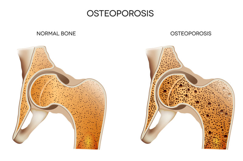 Elderly Care in Hillcrest CA: Osteoporosis